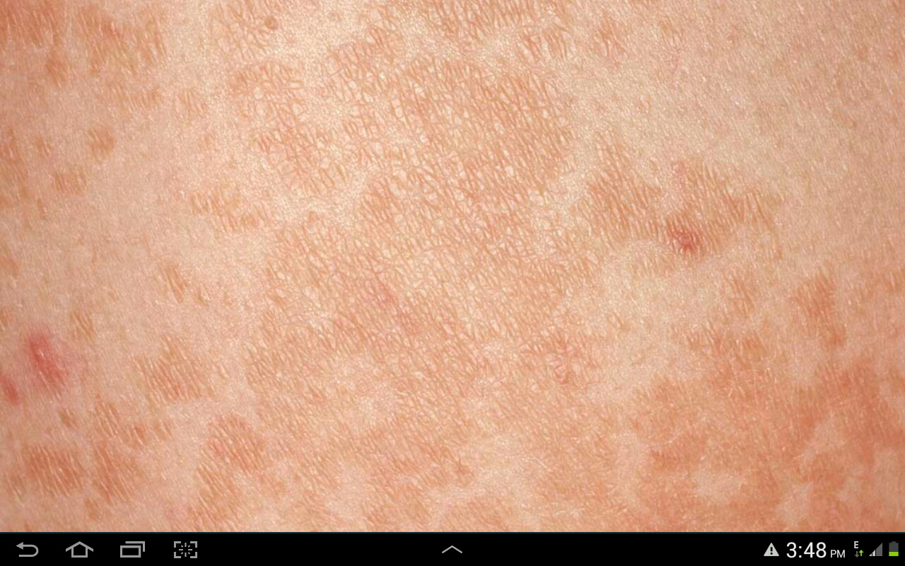 My Residency in Pediatrics Tinea Versicolor