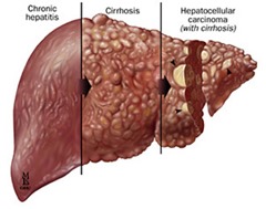 hepatitis-c-symptoms-and-progression