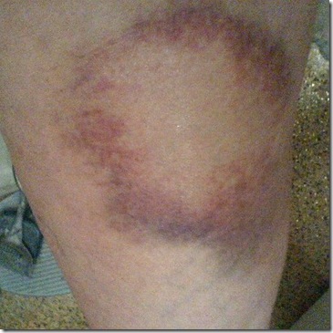 bruise day 6