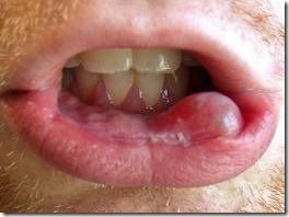 mucocoele, bump inside lower lip