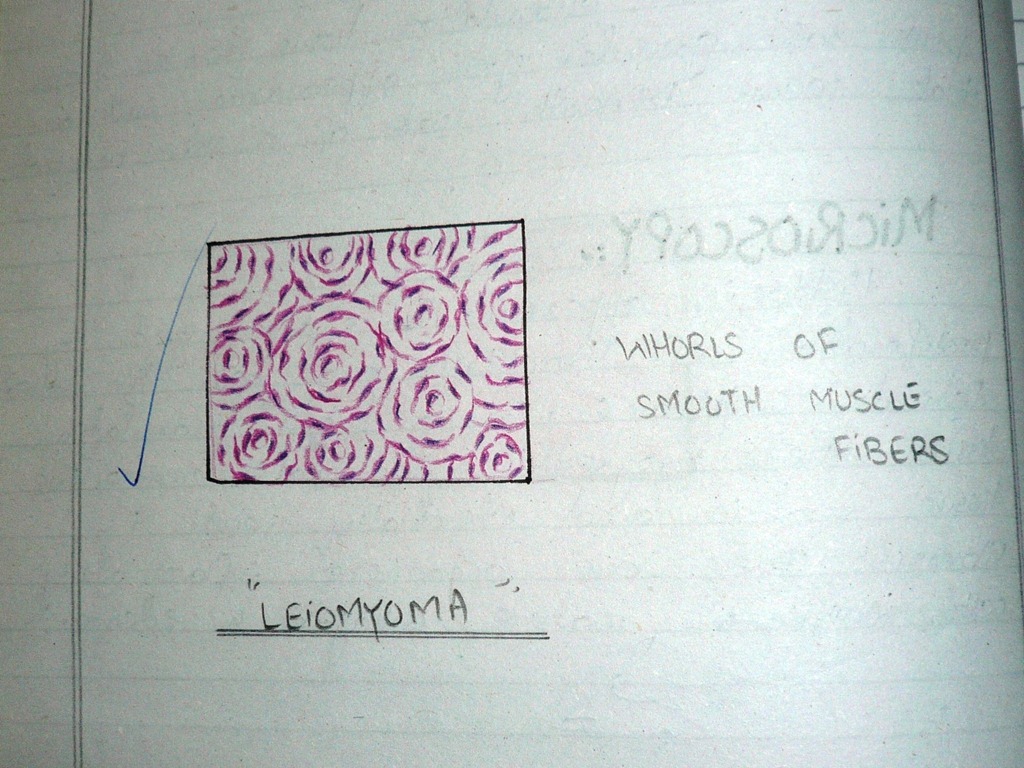 [leiomyomadiagramhistopathology2.jpg]