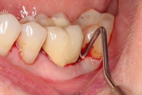 home remedies for abcessed tooth_2