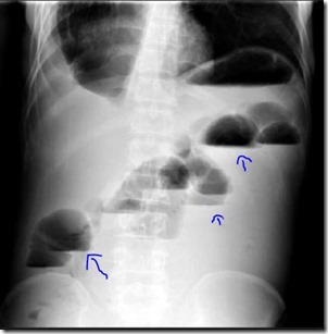 Xray with air fluid levels, intestinal obstruction