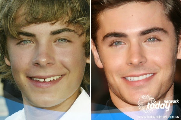 Zac Efron lost the toothy gap and became a true Hollywood hunk! (Getty Images) 
