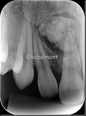 odontoma complexo periapical 2 odontoma complexo periapical 2