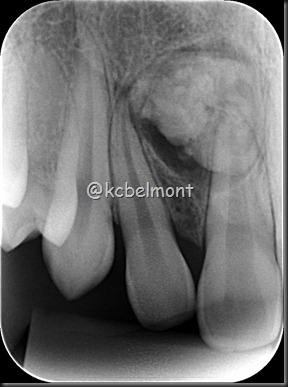 odontoma complexo periapical 2