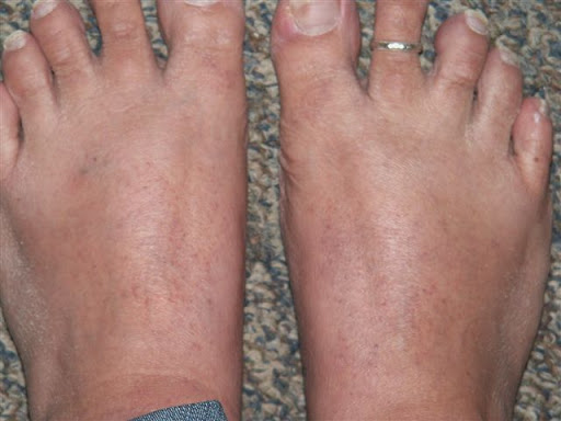 spider bite rash spreading. Bartonella rash- small