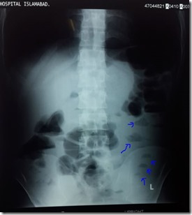 X-RAY erect abdomen with air fluid level, Dr siddique akbar satti