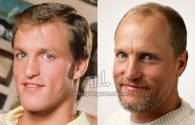 La caida del pelo de Woody Harrelson