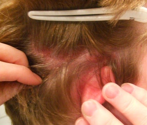 home remedies for dandruff and dry scalp_5
