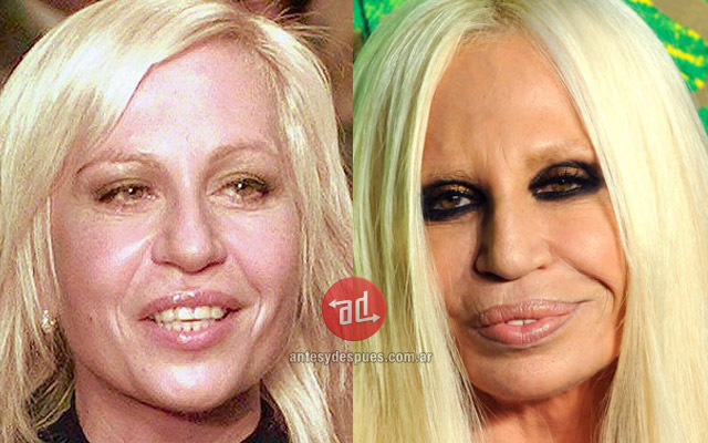 Lip augmentation of Donatella Versace