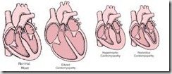 cardiomiopatia restrittiva nel gt