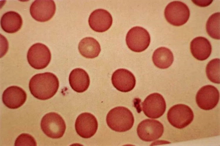 Esferocitose Hereditária | Biomedicina Padrão