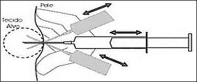 Procedure of Fine Needle Aspiration FNA