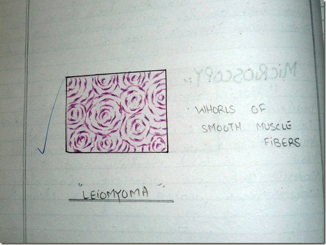 leiomyoma diagram histopathology