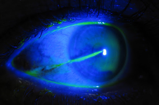 Chemical Eye Burn Symptoms First Aid Treatment  Surgery