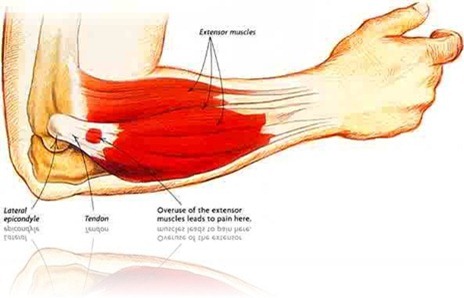 comment soigner une tendinite au bras droit