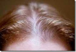 webmd_rf_photo_of_thinning_hairline_woman hair front of the head
