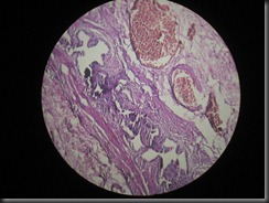 cholecystitis high resolution histology slide tsnaps