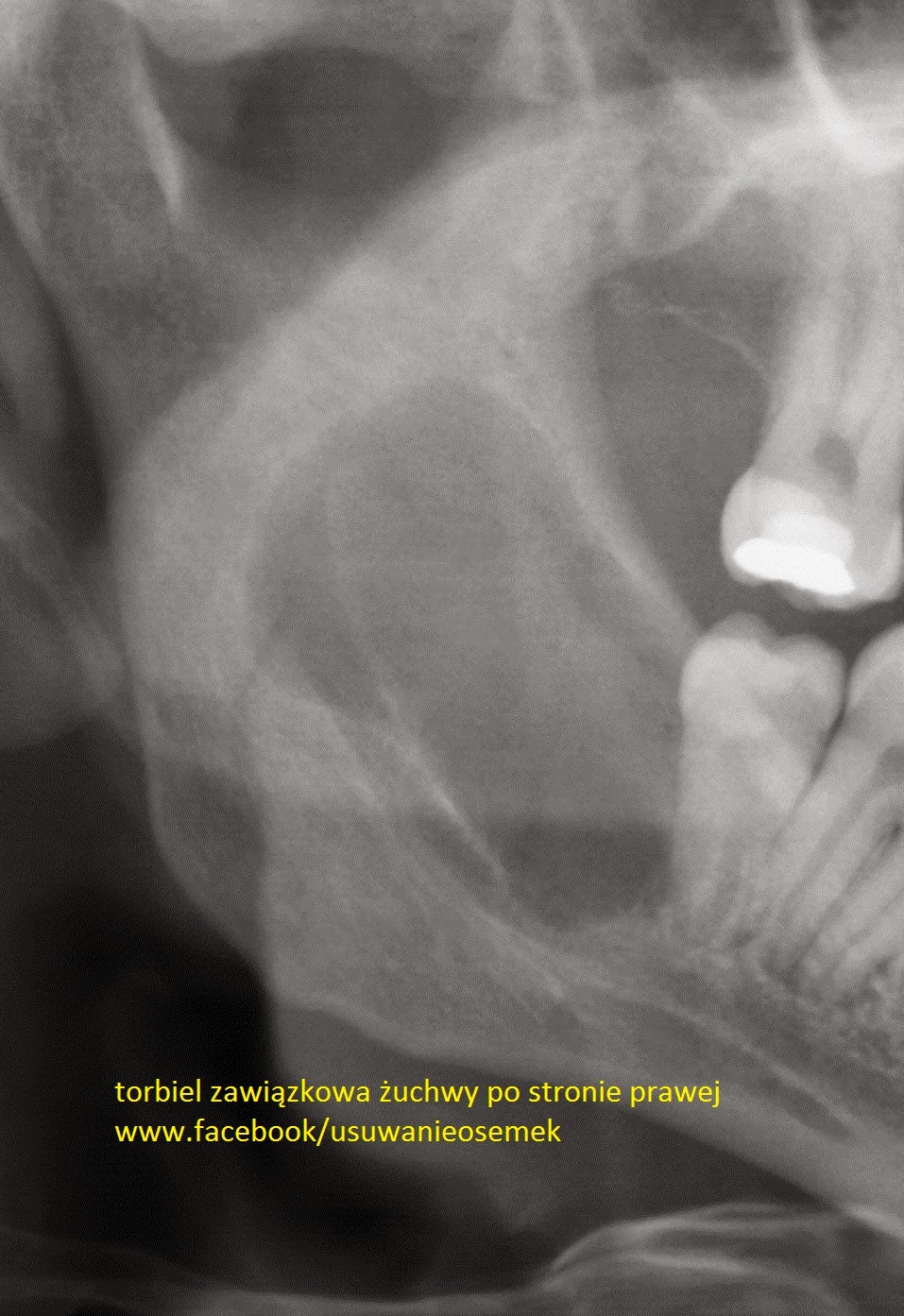 Torbiele Retencyjne W Zatoce Szczekowej Wojciech Bukowski chirurg dentysta: 2014