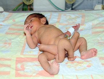 bebê-nasce-com-6-pernas