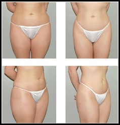 liposuction-surgery5
