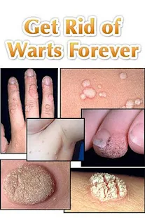 Get Rid of Warts Forever