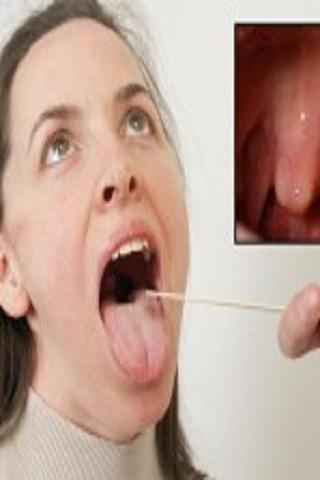 【免費健康App】How To Prevent Tonsil Stones-APP點子