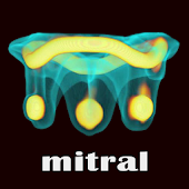 ViV Mitral