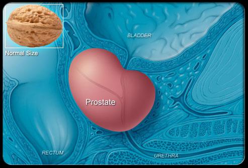 Prostate Cancer Symptoms