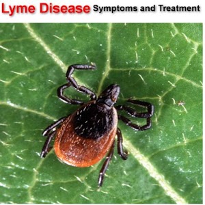Lyme Disease +