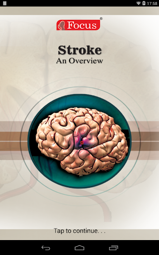 Stroke- An Overview