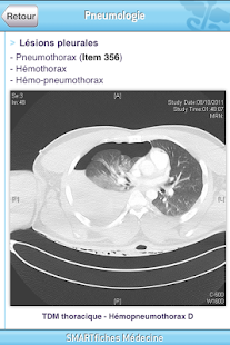 How to get SMARTfiches Pneumologie lastet apk for bluestacks