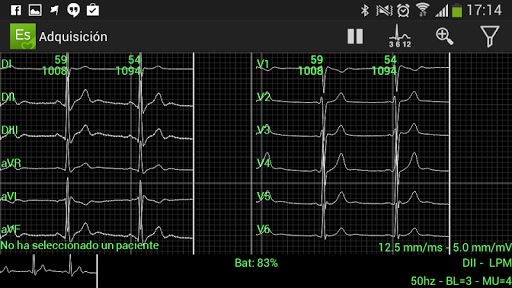 ElectroSmart ECG