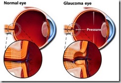 glaucoma_eye