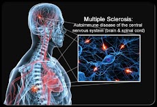 Multiple Sclerosis Treatmentのおすすめ画像4