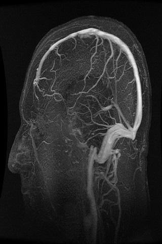 Multiple sclerosis MS