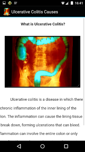 免費下載醫療APP|Ulcerative Colitis Causes app開箱文|APP開箱王