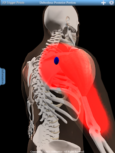 3D Trigger Points