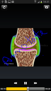 How to get Atlas of Rheumatoid Arthritis patch v1.4 apk for bluestacks
