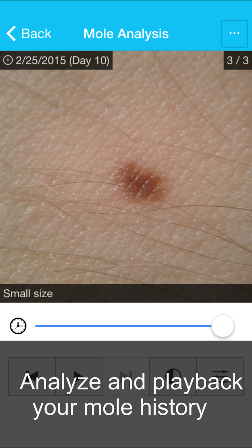 Skin Cancer App - MySkinPal Screen 3