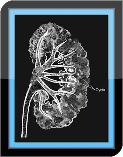 Kidney Infection - Guide