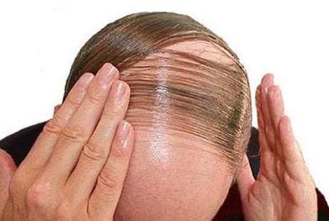 How to mod Hair Fall Control 1.0 mod apk for pc