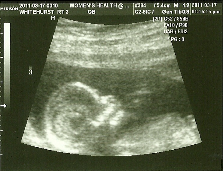 [Baby 3 @ 13 weeks (profile)[2].jpg]