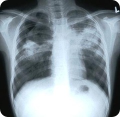 tuberculosis-cough