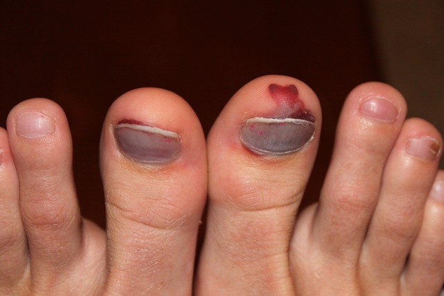 [my poor toes 10-2-2010 7-19-39 PM[3].jpg]