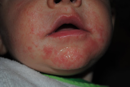 baby drool rash itchy
