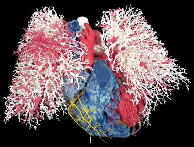 image shows the heart and blood vessels of the lungs