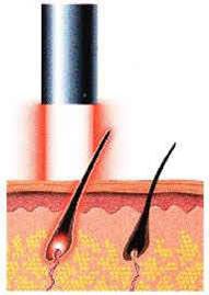laser hair removal laser hair removal
