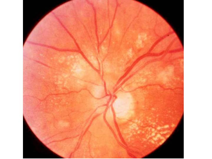 [hypertensive+retinopathy.jpg]